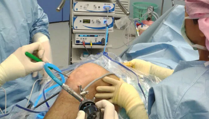 Chirurgie arthroscopique