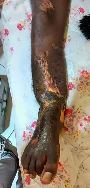 Reconstruction d'une perte osseuse du tibia par la méthode d’Ilizarov
