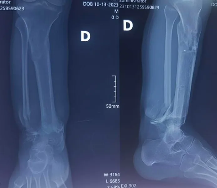 Reconstruction d'une perte osseuse du tibia par la méthode d’Ilizarov