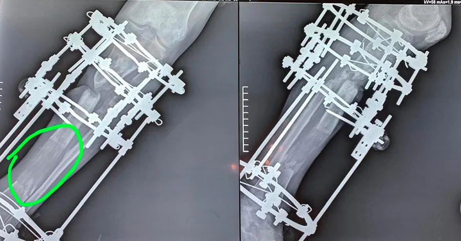 Reconstruction d'une perte de substance osseuse tibiale