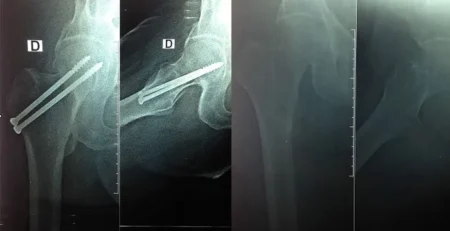 Fracture du col fémoral fixée par deux vis