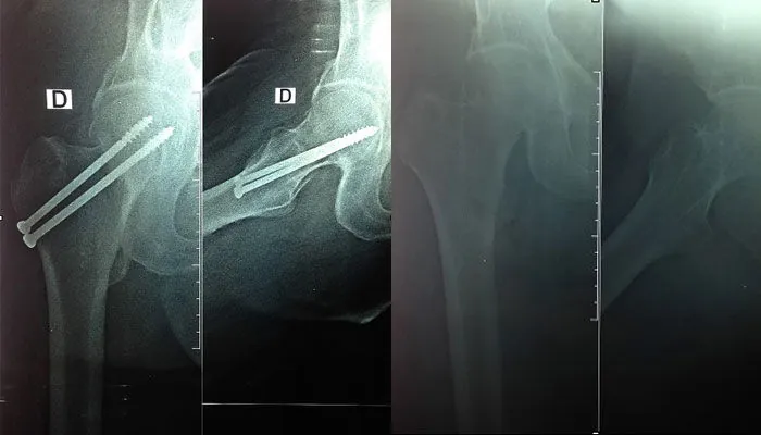 Fracture du col fémoral fixée par deux vis