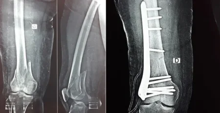 Traitement chirurgical d'une fracture complexe