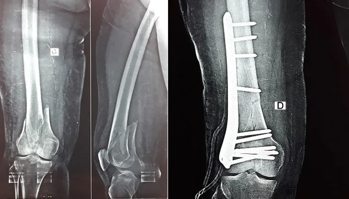 Traitement chirurgical d'une fracture complexe