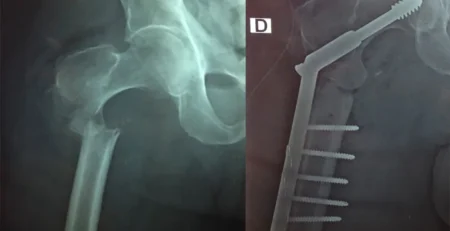 Fracture du fémur