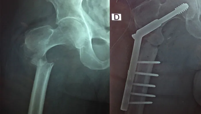 Fracture du fémur
