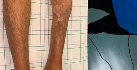 Reconstruction d'une perte de substance osseuse tibiale