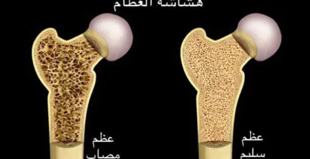 هشاشة العظام