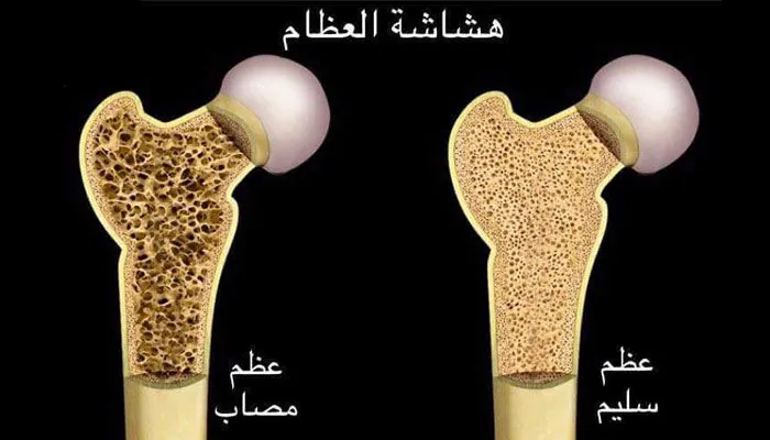هشاشة العظام