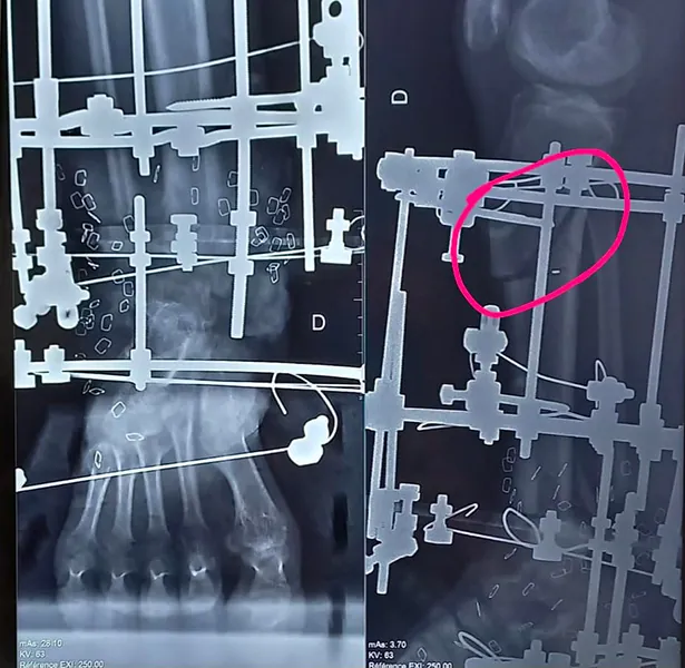 Reconstruction d'une perte osseuse du tibia par la méthode d’Ilizarov