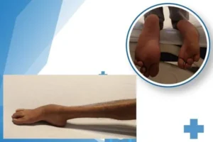 Traitement du Pied Bot Varus Équin Invétéré par Fixateur Externe d'Ilizarov