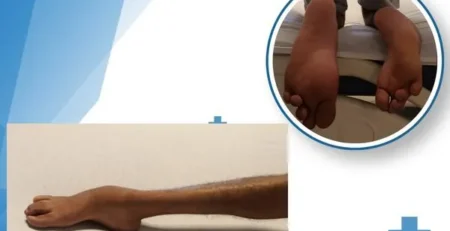 Traitement du Pied Bot Varus Équin Invétéré par Fixateur Externe d'Ilizarov