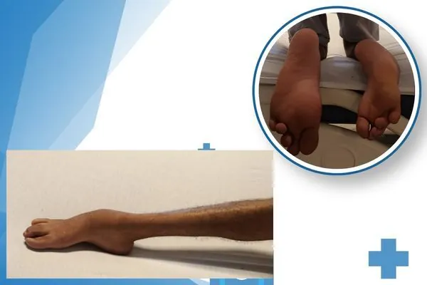 Traitement du Pied Bot Varus Équin Invétéré par Fixateur Externe d'Ilizarov