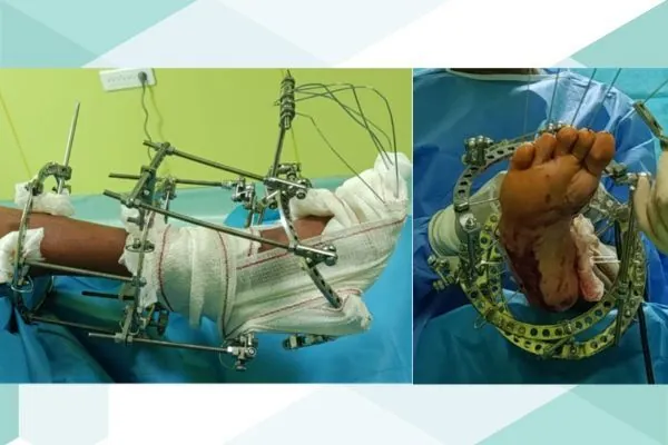 Traitement du Pied Bot Varus Équin Invétéré par Fixateur Externe d'Ilizarov