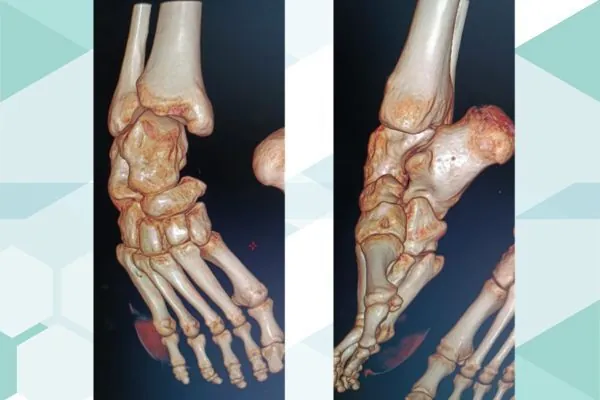 Traitement du Pied Bot Varus Équin Invétéré par Fixateur Externe d'Ilizarov