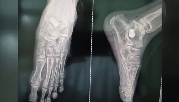 Observation Clinique : Chirurgie du Pied Plat Valgus de l'Enfant