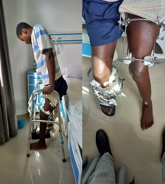 Reconstruction d'une perte osseuse du tibia par la méthode d’Ilizarov