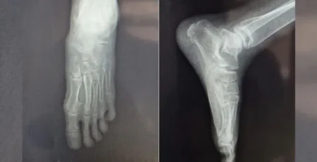 Observation Clinique : Chirurgie du Pied Plat Valgus de l'Enfant