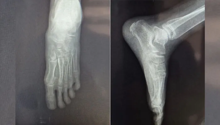 Observation Clinique : Chirurgie du Pied Plat Valgus de l'Enfant